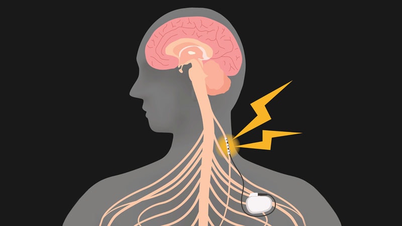 https://img.medscape.com/thumbnail_library/gty_210429_vagus_nerve_stimulation_800x450.jpg