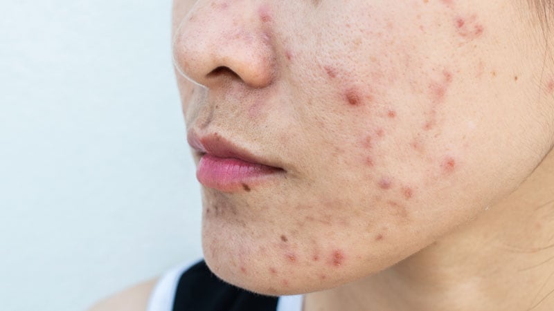 Les antioxydants topiques avec laser peuvent prévenir les cicatrices d’acné