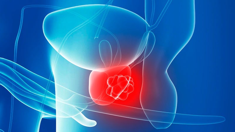 „Behandlungsurlaub“ bei Prostatakrebs mit maßgeschneiderter Dosierung