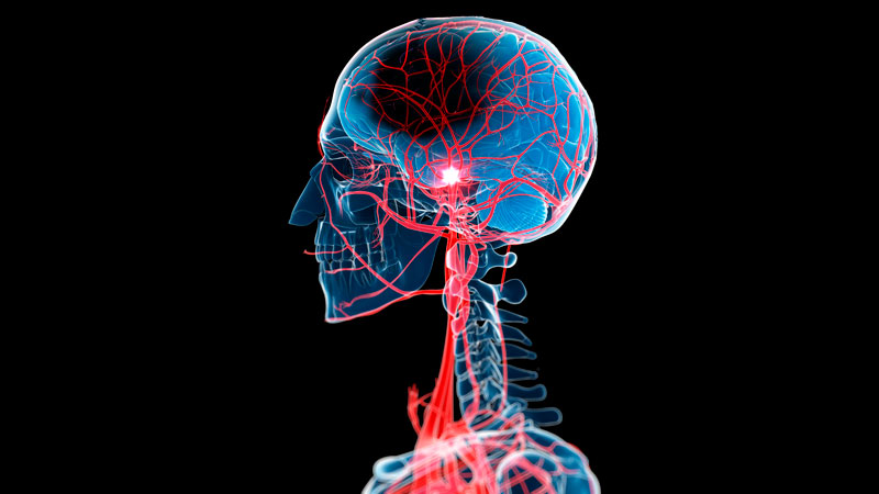 No Protective Effect of Cognitive Reserve in Vascular Brain Injury