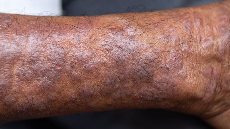 How Does Atopic Dermatitis Present In Skin Of Color