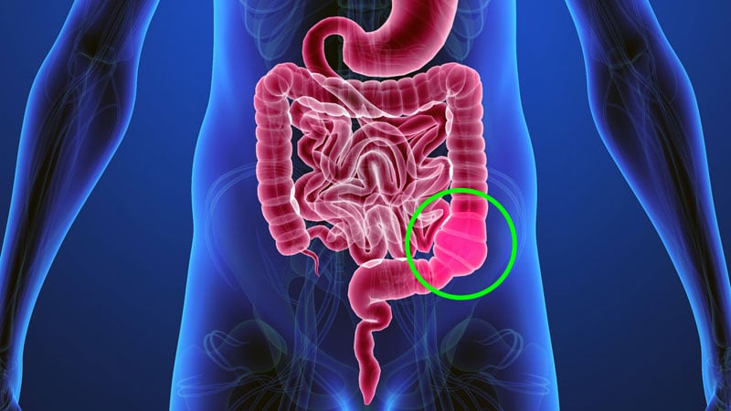 Une équipe identifie les principaux facteurs de risque de constipation dans le cancer gastro-intestinal