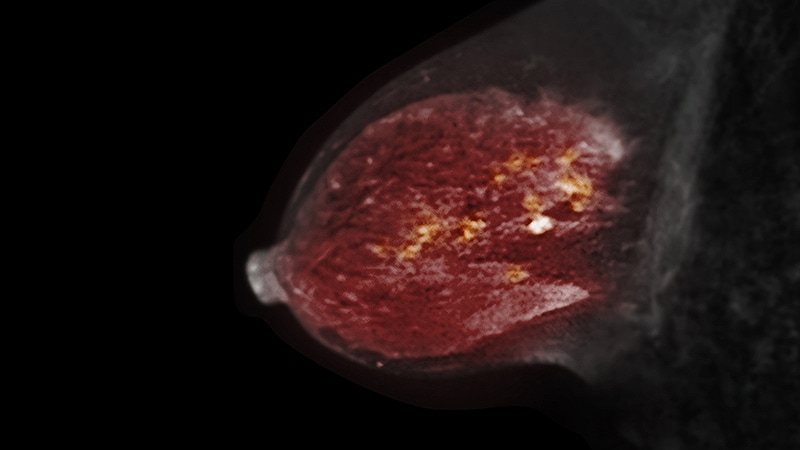 Disparities in Breast Cancer Mortality, Sustained MRI Screening