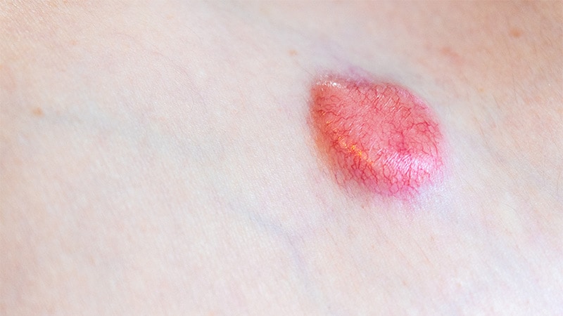 L’irradiation superficielle guidée par l’image en première intention dans le cancer de la peau ?