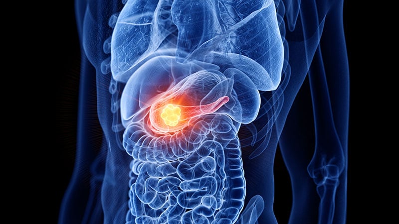 Lower Dose FOLFIRINOX Effective, Safer for Pancreatic Cancer