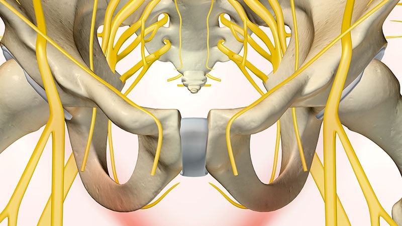 Sacral Nerve Stimulation May Aid Female Sexual Dysfunction