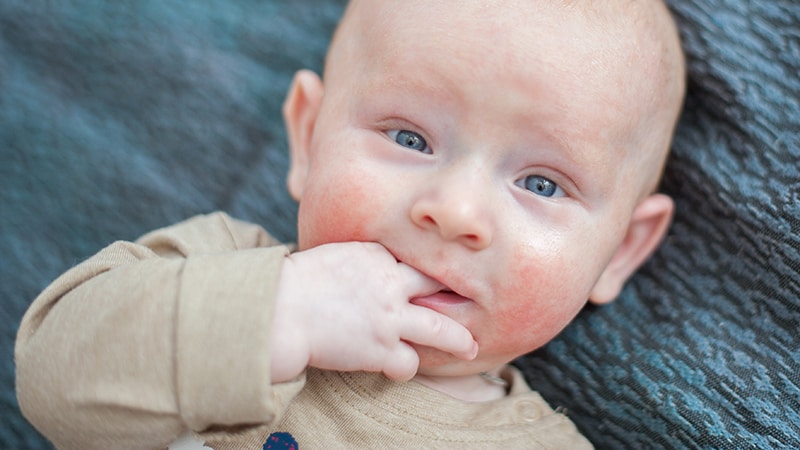 Anaphylaxie infantile : une étude caractérise les symptômes et le traitement