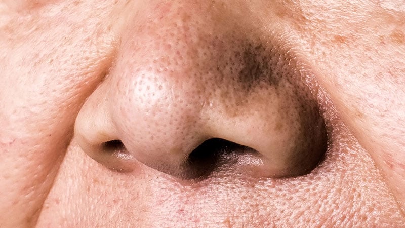 La perte du sens de l’odorat laisse présager des problèmes de santé chez les personnes âgées