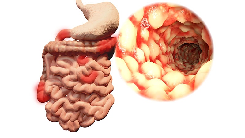 Genetic Risk, Lifestyle Factors Can Lead to Adult-Onset IBD