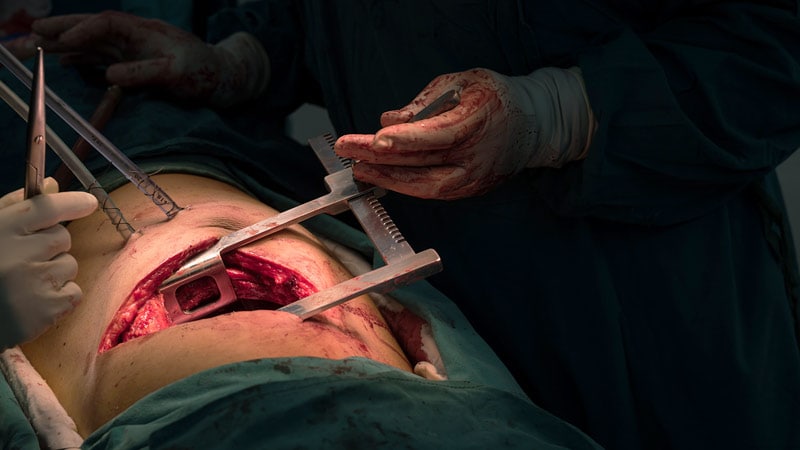 La chirurgie moins invasive du NSCLC ne compromet pas la survie