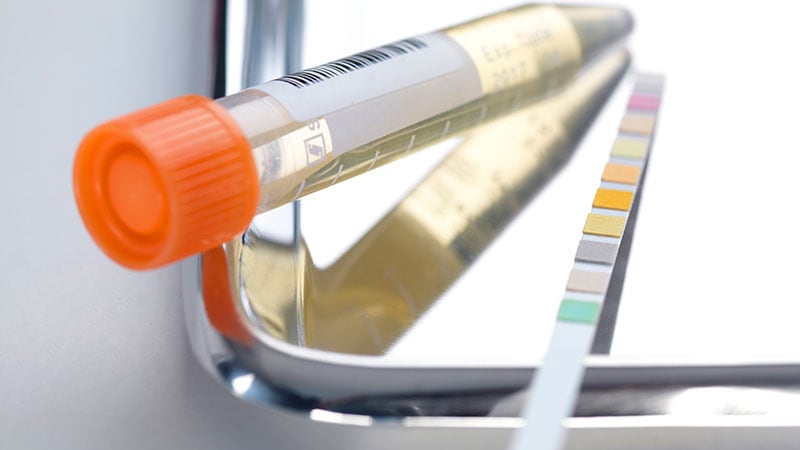 Urine Test Shows Promise for Diagnosing Urothelial Carcinoma