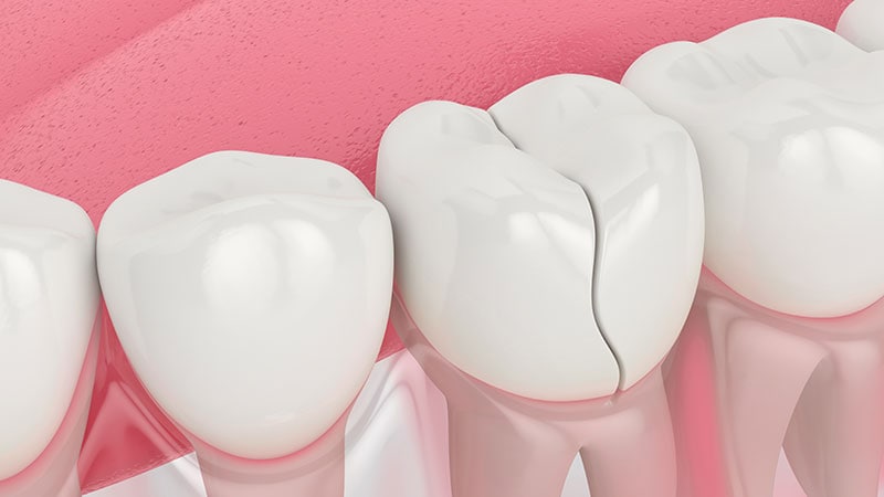 L’ECT modifié réduit le risque de fracture dentaire et squelettique