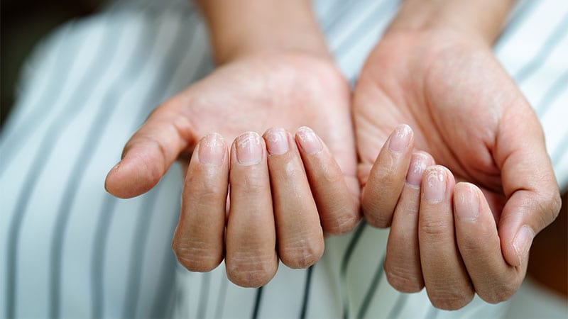 Il existe des options de traitement limitées pour le syndrome des ongles cassants