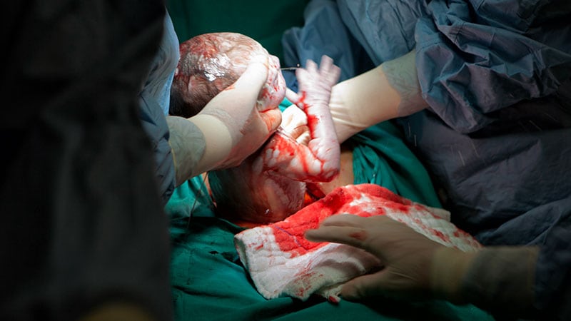 Un algorithme réduit le délai d’incision lors des accouchements urgents par césarienne