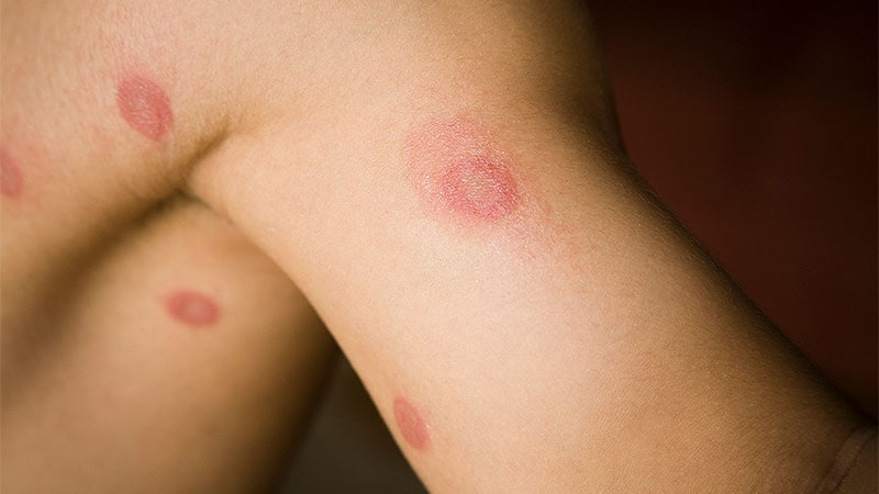 CDC Reports Two Cases of Drug-Resistant Ringworm