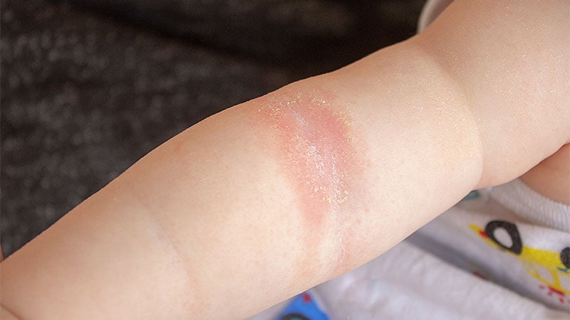 Roflumilast Cream Protected, Efficient for Youngsters With Psoriasis