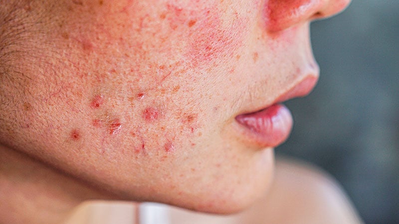 Une analyse révèle les tendances récentes en matière de prescription d’acné