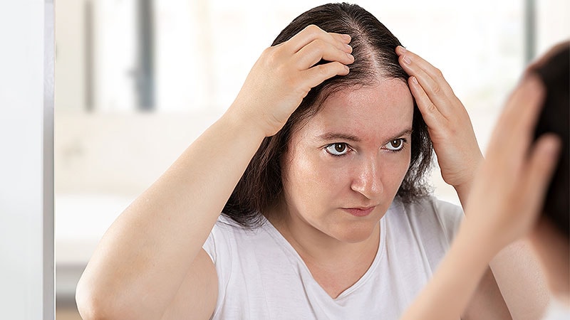 Minoxidil oral pour la perte de cheveux chez les femmes évalué dans une étude