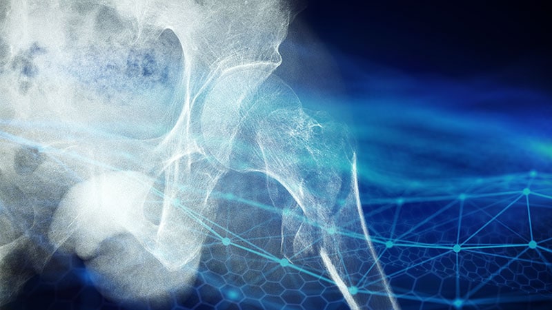 Une nouvelle IA pourrait réduire le taux de mortalité élevé après des fractures de la hanche