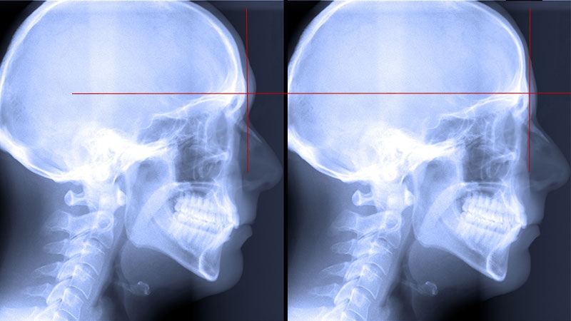 La cranioplastie féminisante entraîne des changements mesurables