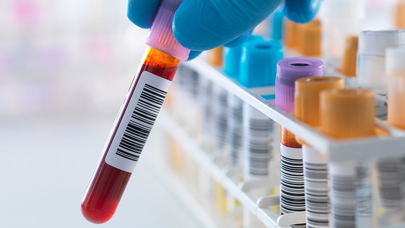 Un nouveau test sanguin peut détecter la polyarthrite rhumatoïde