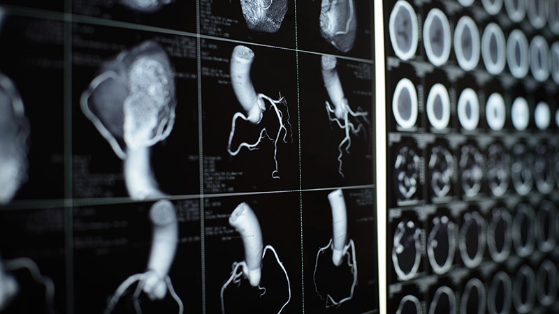 AI Interpretation of CCTA: Inflammation as CV Risk Factor