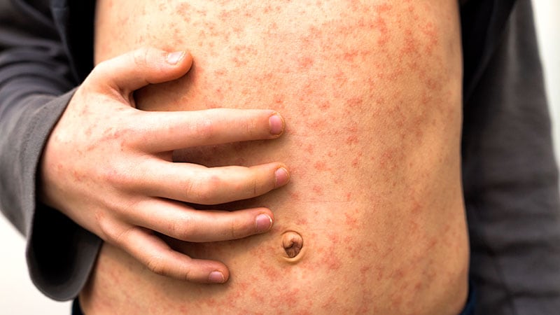 Can You Identify That Pediatric Rash?