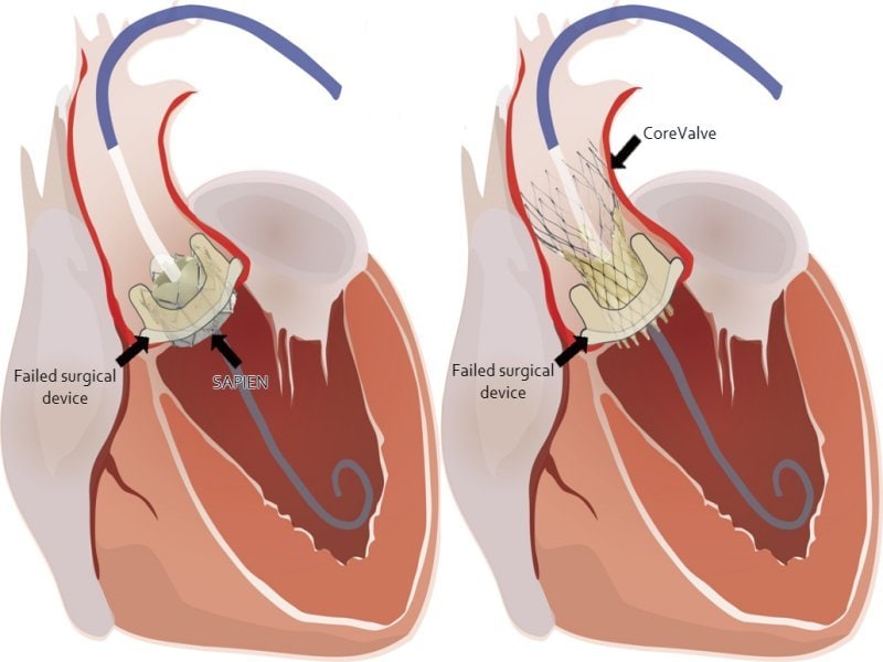 Mechanical and Bioprosthetic Aortic Valves Equal at 15 Years