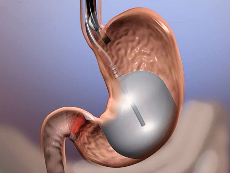 Brazil Study Gastric Balloon Valid Option but Outcomes Not Durable