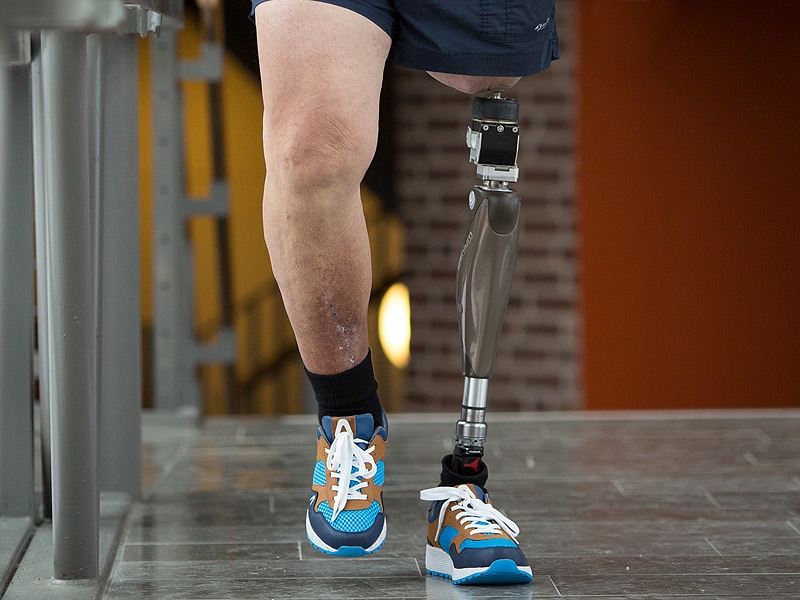FDA Approves First Of Kind Leg Prosthesis