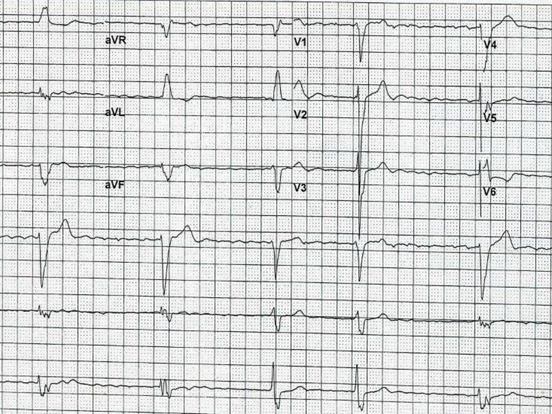 ECG Challenge: History of AF