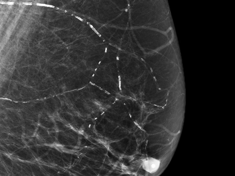 Breast Arterial Calcification Potential Marker for CVD