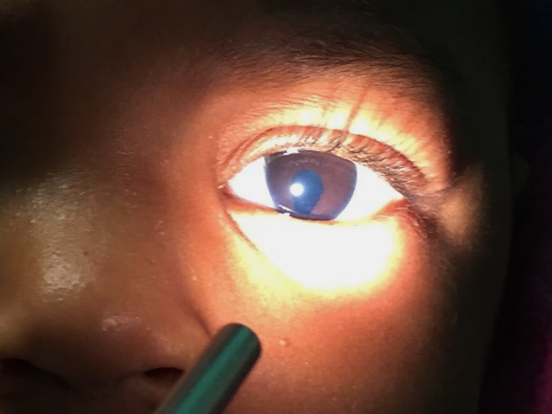 coloboma pupil