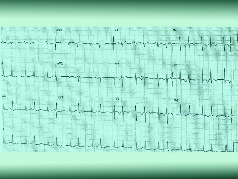 ECG Challenge: A Hypertensive Crisis