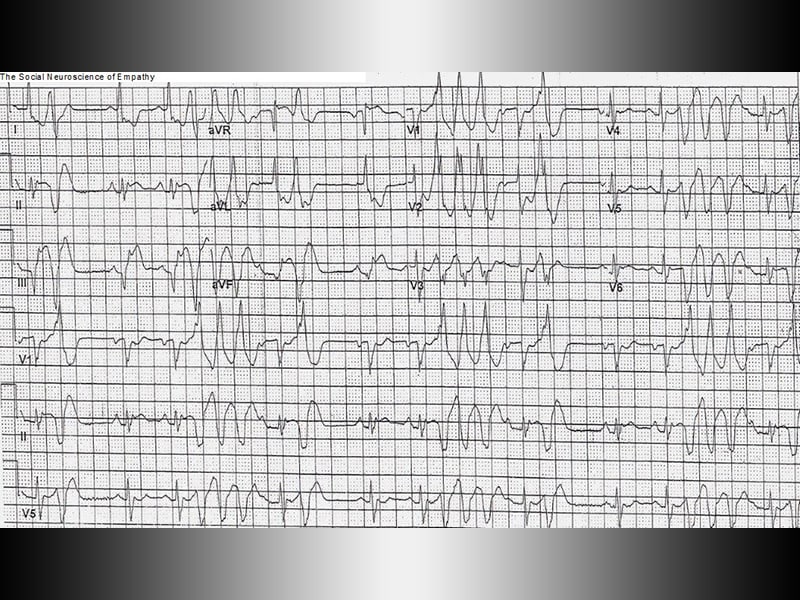 Crushing Chest Pain: What Does His ECG Show? - Page 2