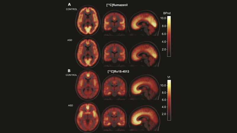 First Biomarker Evidence Of Ddt Autism >> Pet Scans Show No Brain Gaba Receptor Deficiency In Autism First Biomarker Evidence Of Ddt Autism >> Pet Scans Show No Brain Gaba Receptor Deficiency In Autism