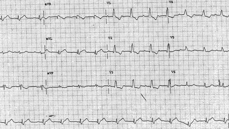 ECG Challenge: Her Annual Physical Is Normal, Except the ECG