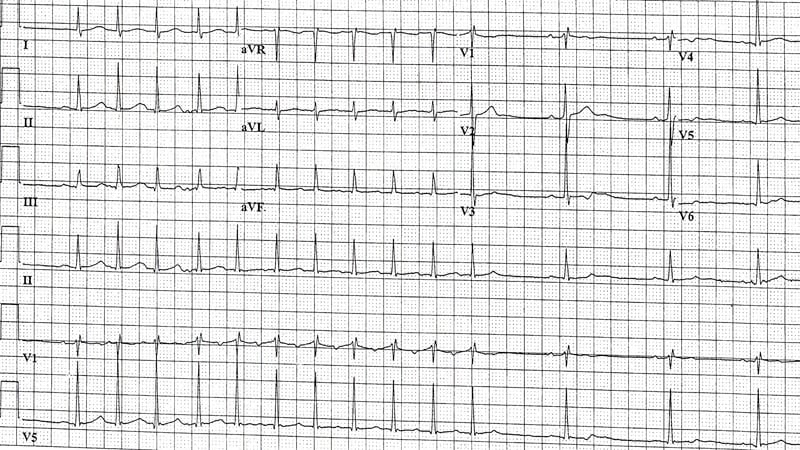 ECG Challenge: An Unexpectedly Rapid Heart Rate in the ED