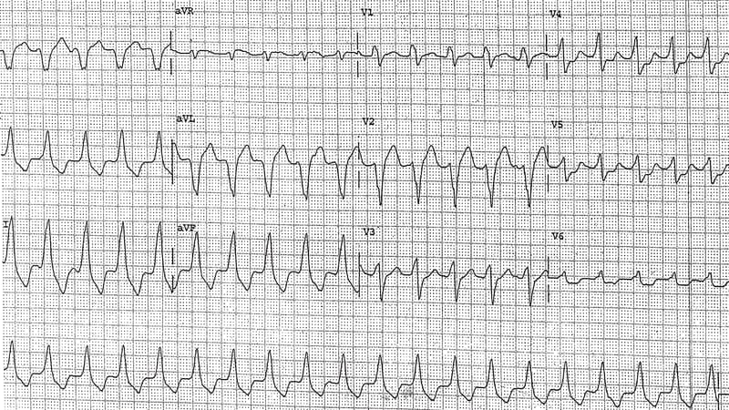 Emergency In A Dilated Cardiomyopathy Patient