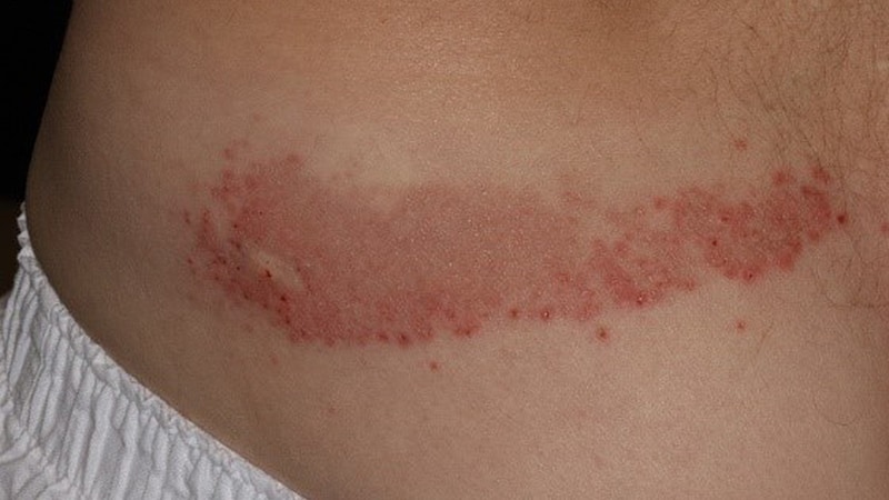 A 38-Year-Old Dog Owner With a Blistering, Itchy Rash - Page 2