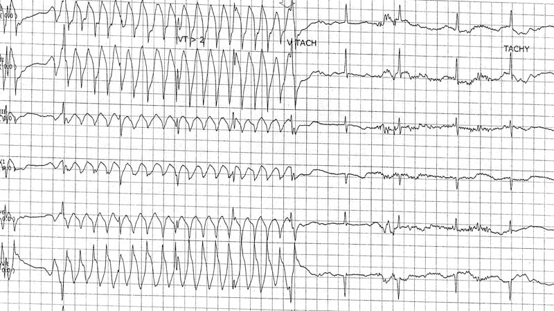 ECG Challenge: Abnormal Telemetry Before Cholecystectomy