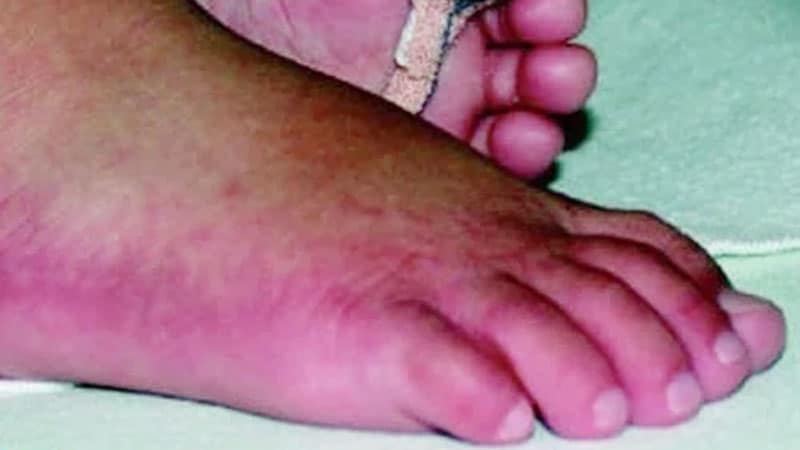 a-young-girl-with-discolored-feet-facial-swelling-and-cough