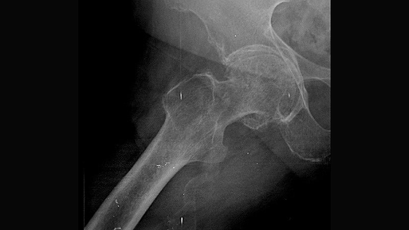 L’utilisation de DEXA pour évaluer l’arthrose de la hanche pourrait faciliter le diagnostic et le pronostic