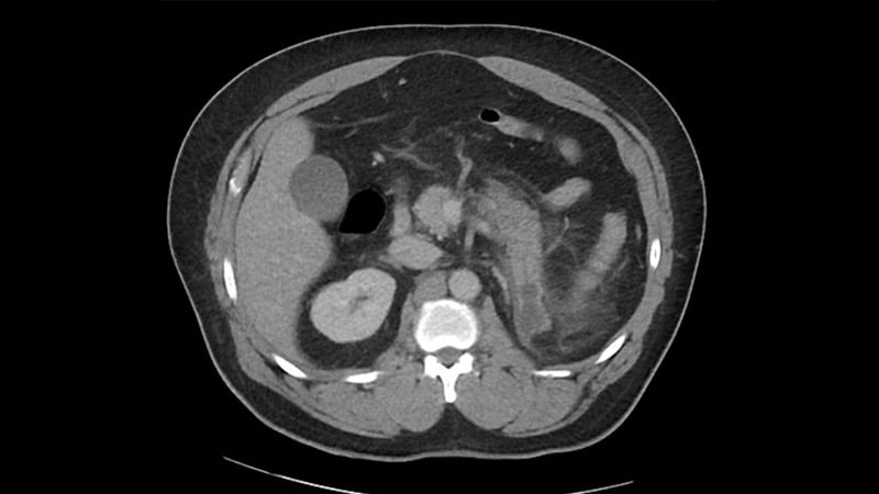 pain-vomiting-in-a-48-year-old-on-levothyroxine-metformin