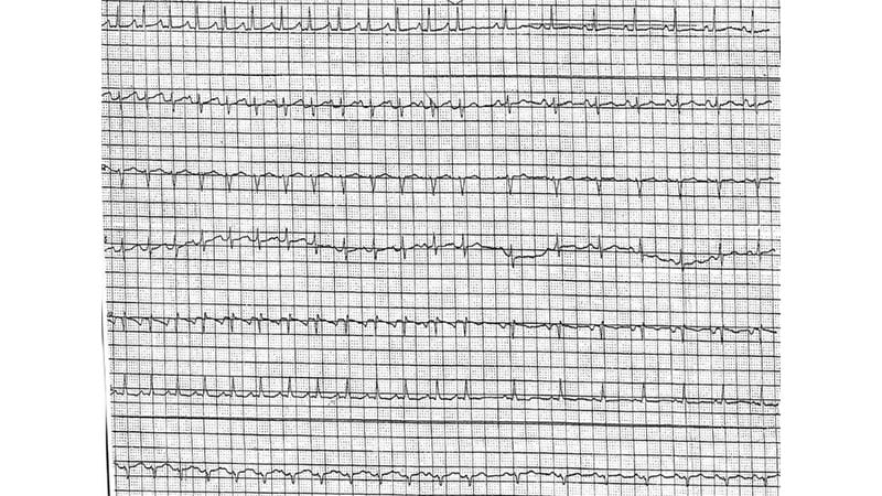 ecg-challenge-mid-sternal-pain-with-exercise