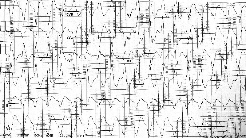 ecg-challenge-af-patient-with-lightheadedness-rapid-pulse-page-2