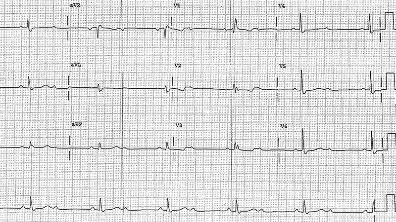 ECG Challenge: Slow Heart and Cellulitis