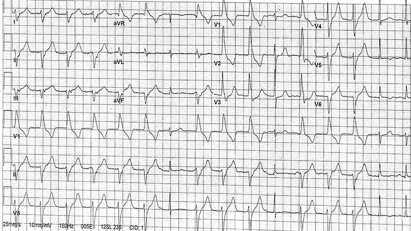 ECG Challenge: Fever After Oral Surgery in a Cardiac Patient - Page 2