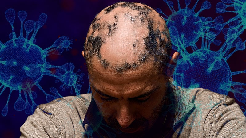 COVID-19–Alopecia Areata Link? Review Doesn't Find Much Evidence