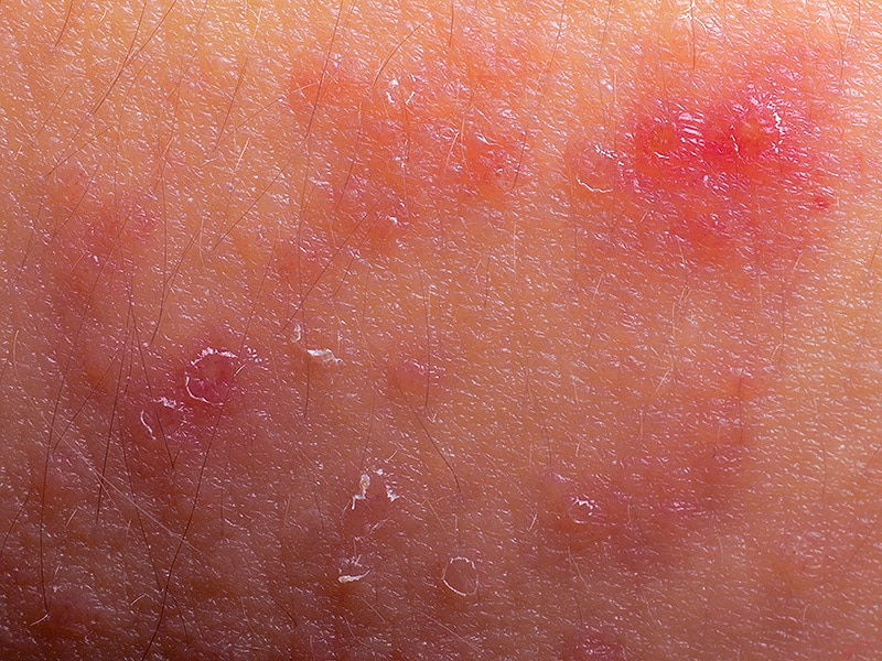 what does a methotrexate rash look like
